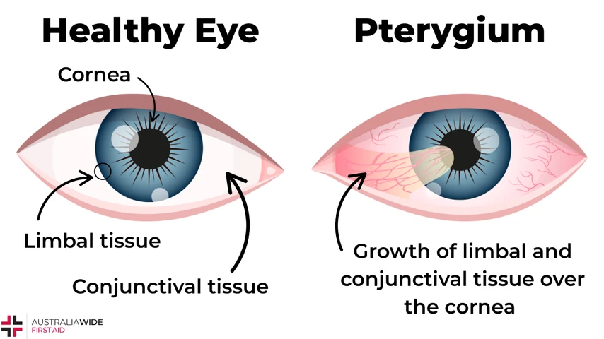 pterygium graphic